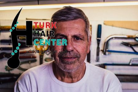 زراعة الشعر في جدة تقنياتها الحديثة مميزاتها تورك هير turk hair